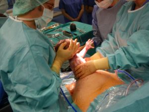 операция кесарево сечение - последствия