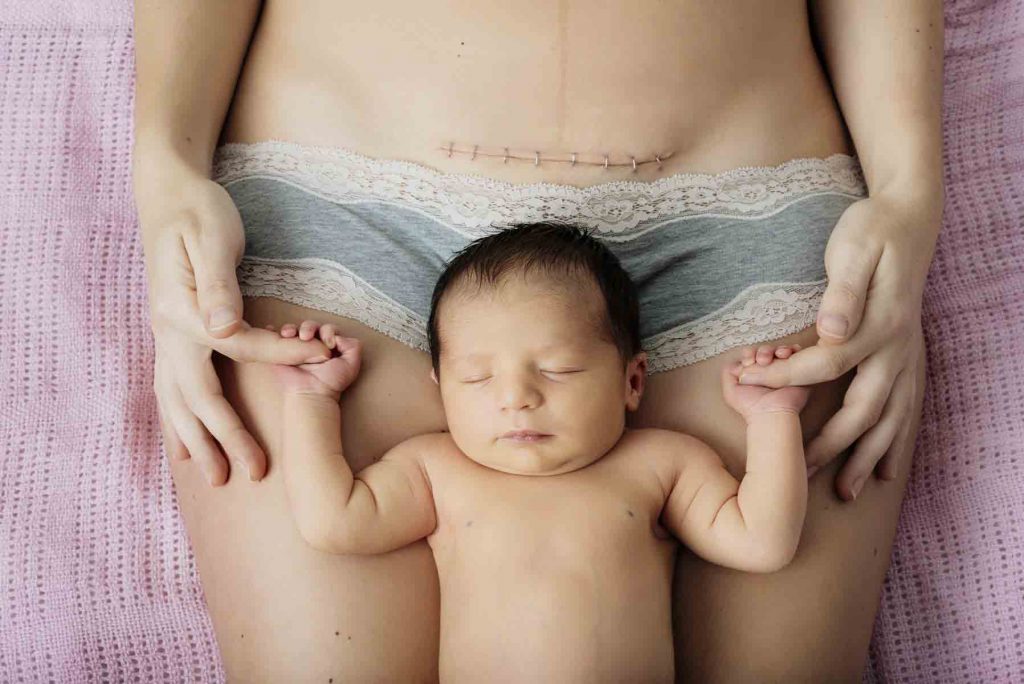 Беременность после кесарева сечения – возможно? Когда планировать еще одного ребенка