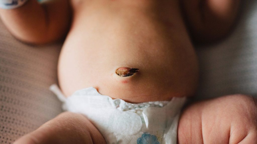 Пуповина новорожденного – когда отпадает и что делать после, как ухаживать, кровотечение и другие проблемы